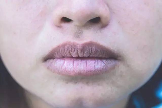 嘴唇发紫绀的图片图片